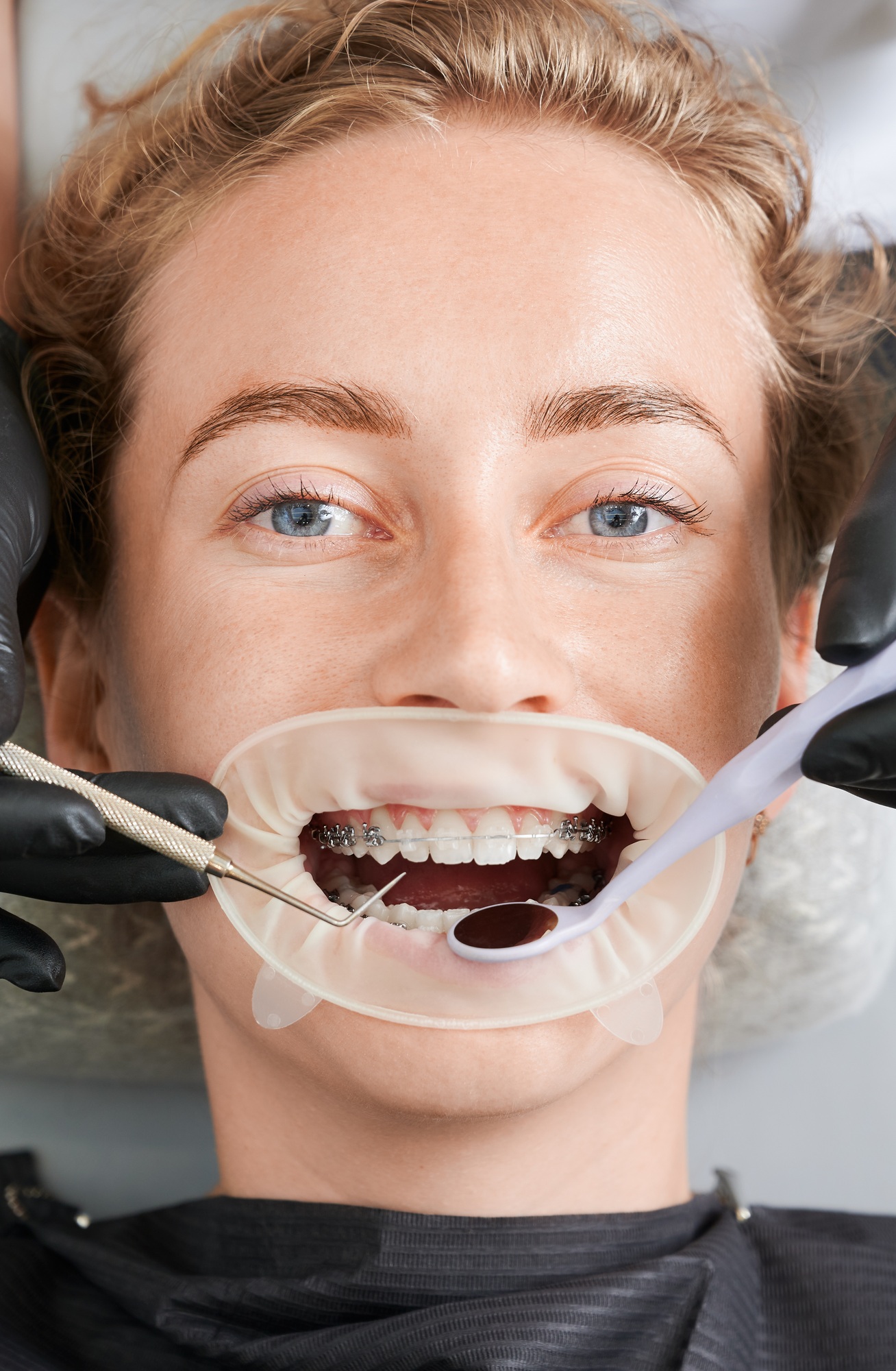 Female patient with braces on teeth receiving orthodontic treatment.